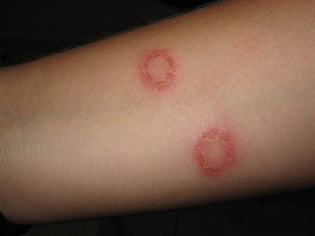 Ringworm Fungal Infections Symptoms Causes Treatment Prevention