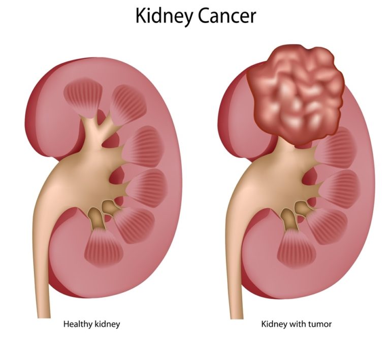Renal Cell Carcinoma Symptoms Causes Diagnosis Treatment Healthmd