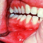Mouth Sores