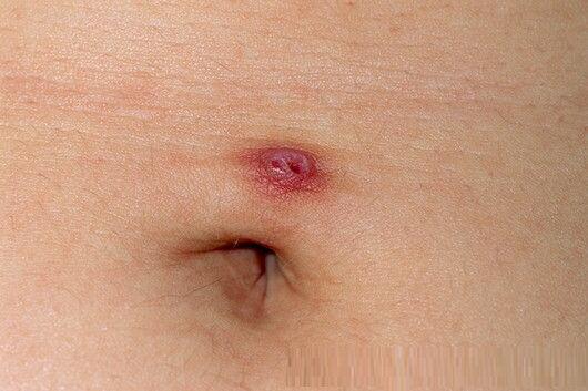 Belly Piercing infection