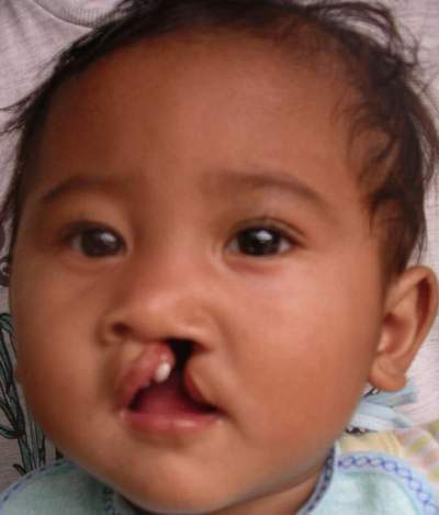 Cleft lip | Cleft Lip and Palate | Cleft Lip Causes | What Causes Cleft