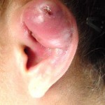 Ear Piercing Infection