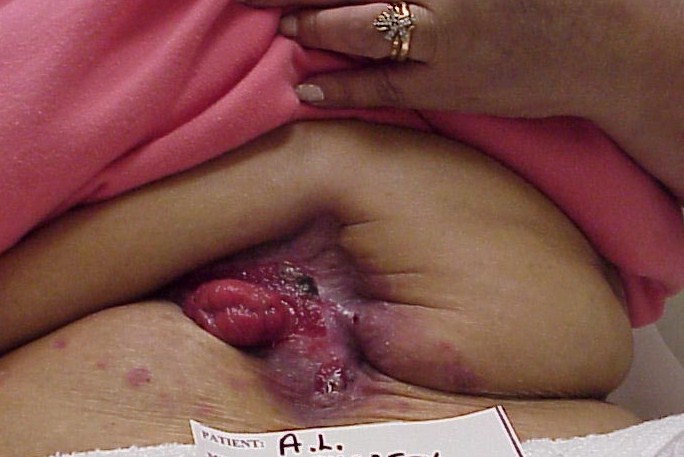 Anal Fistula - Symptoms, Causes, Surgery, Treatment. 