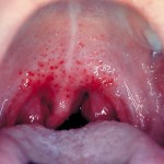 Oral Gonorrhea