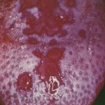 Oral Gonorrhea