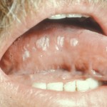 Oral Hairy Leukoplakia
