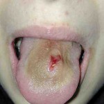 Piercing infection