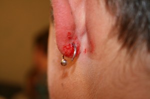 Ear Piercing infection