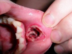 Piercing infection