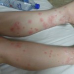 bed bug bites