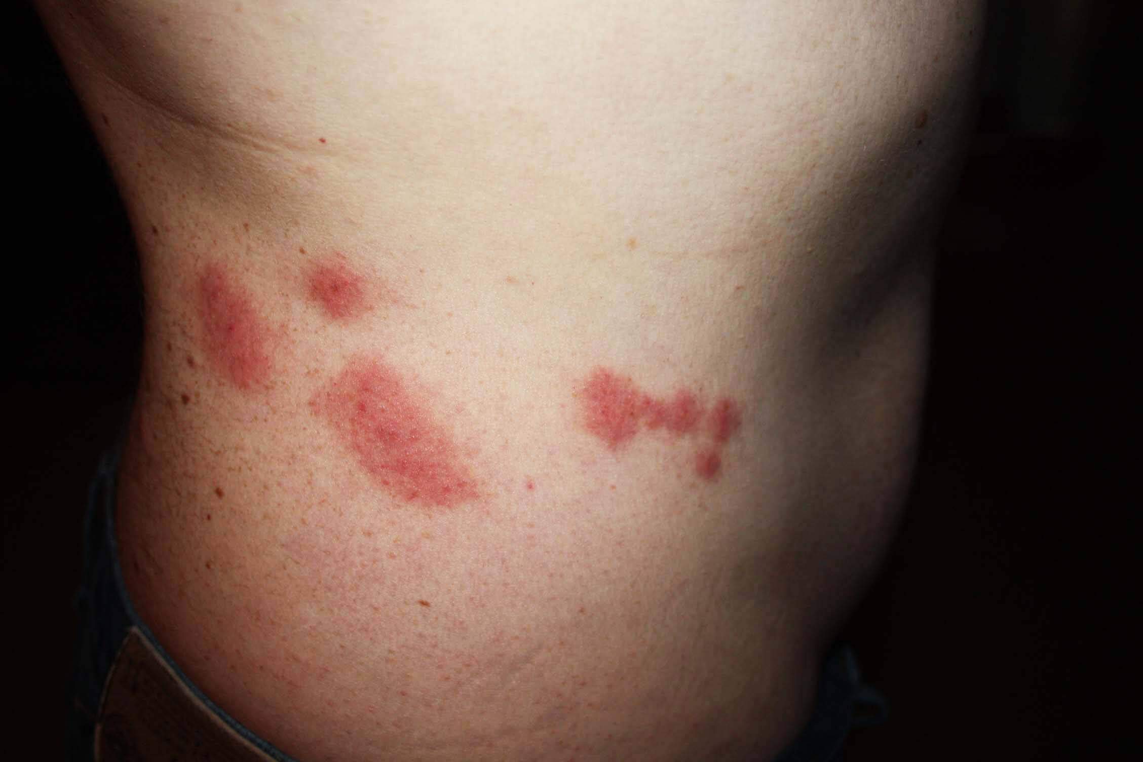 bed bug bites treatment for skin