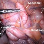 Appendix Pain