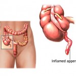 Appendix Pain
