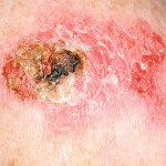 Early Skin Cancer