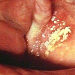 Female Yeast infection