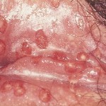 Female Yeast infection