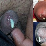 Gonorrhea Male