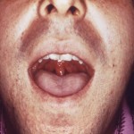 Gonorrhea Mouth