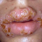Gonorrhea Mouth