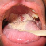 Gonorrhea Throat