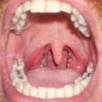 Gonorrhea Throat