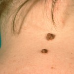Mole Skin Cancer