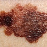 Mole Skin Cancer