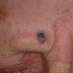 Skin Cancer Face