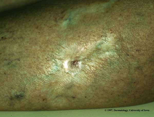 Skin Cancer Leg Pictures Of Skin Cancer On Legs Skin Cancer On Leg