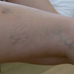 Skin Cancer Leg