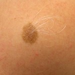Skin Cancer Moles