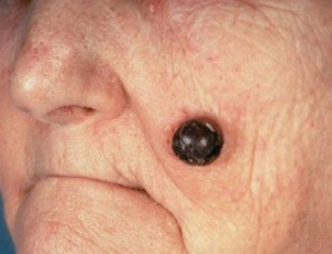 Skin Cancer Moles