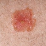 Skin Cancer Symptom