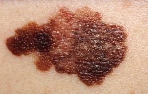 Skin Cancer Type