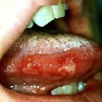 Coxsackie Virus Infection