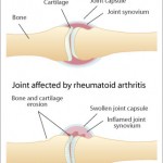 Juvenile Rheumatoid Arthritis