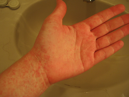 Scarlet Fever Rash Symptoms Pictures Causes Symptoms Treatment