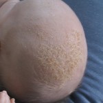 itchy scalp