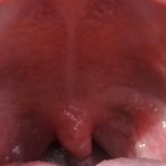 swollen uvula