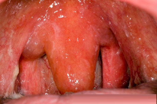 Causes Of Swollen Uvula Throat Symptoms Treatment Remedies Healthmd