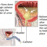 Bladder Infection Symptoms