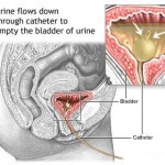 Bladder Infection Symptoms in Women
