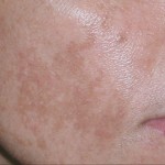 Brown Spots on Face