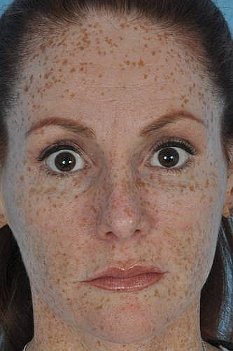 Brown Spots on Face - Causes, Treatment, Prevention, Pictures | Health MD