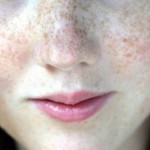 Brown Spots on Face