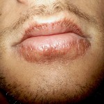 Chapped Lips