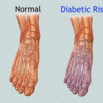 Diabetic Foot Problems