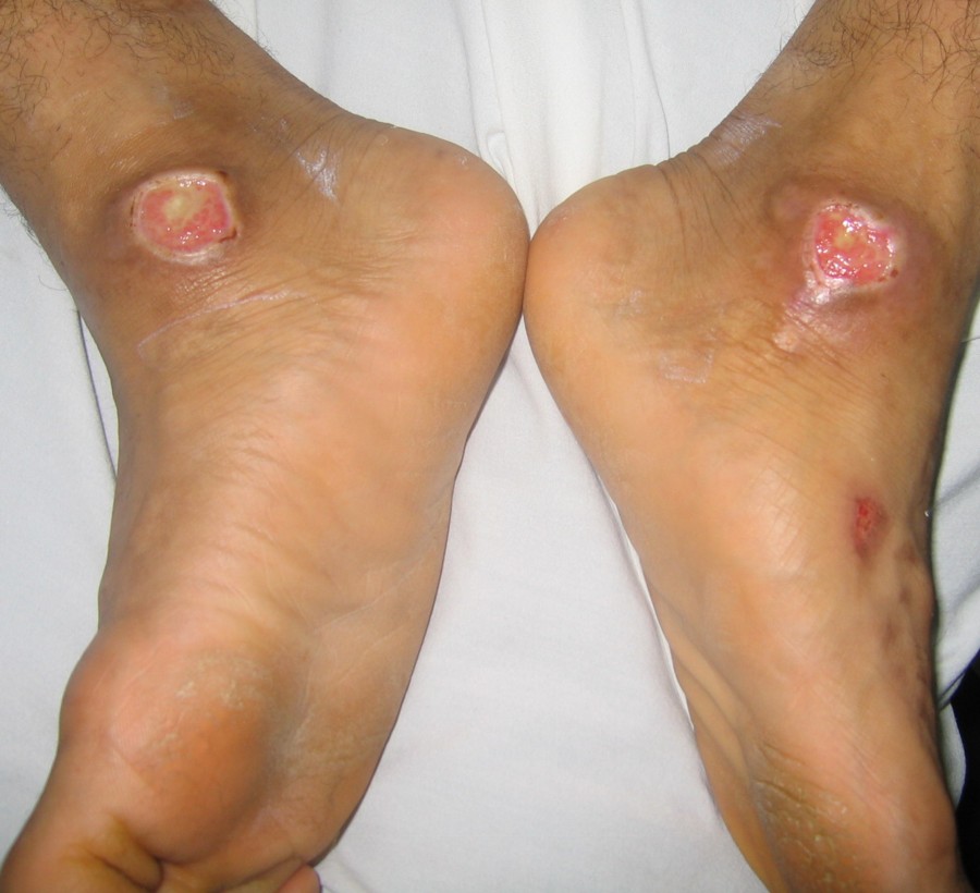 Diabetic Foot Problems Causes Symptoms Treatment Pictures Healthmd