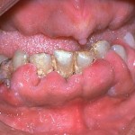 Gum Cancer