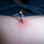 Infected Belly Button Piercing